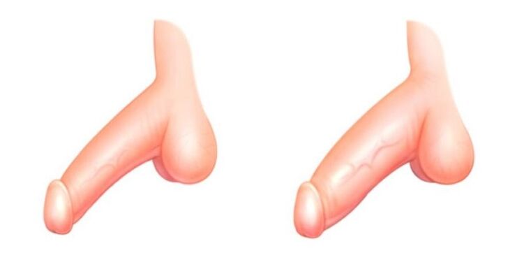 Membro antes e depois de aumentar